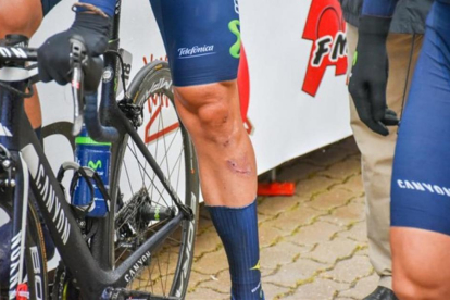 Las cicatrices de Fran Ventoso en la pierna izquierda.-TWITTER @RUEDALENTICULAR