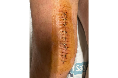Cicatriz en la pierna de Óscar Puente con la mitad de las grapas ya retiradas.- TWITTER