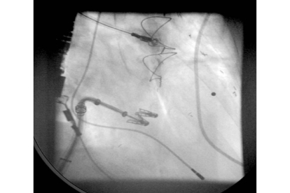 Imagen en el tratamiento percutaneo, angiografía, colocando un segundo clip. Este dispositivo se utiliza en la Unidad de Ciurgía Cardíaca del hospital Clínico de Valladolid