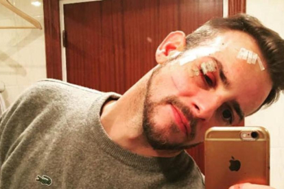 Àlex Casademunt muestra su rostro con múltiples heridas, tras sufrir una agresión el pasado 15 de enero en una discoteca de Vigo-INSTAGRAM