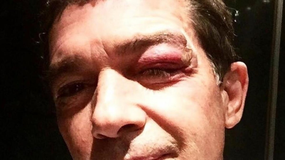 El actor Antonio Banderas, con el ojo morado.-INSTAGRAM