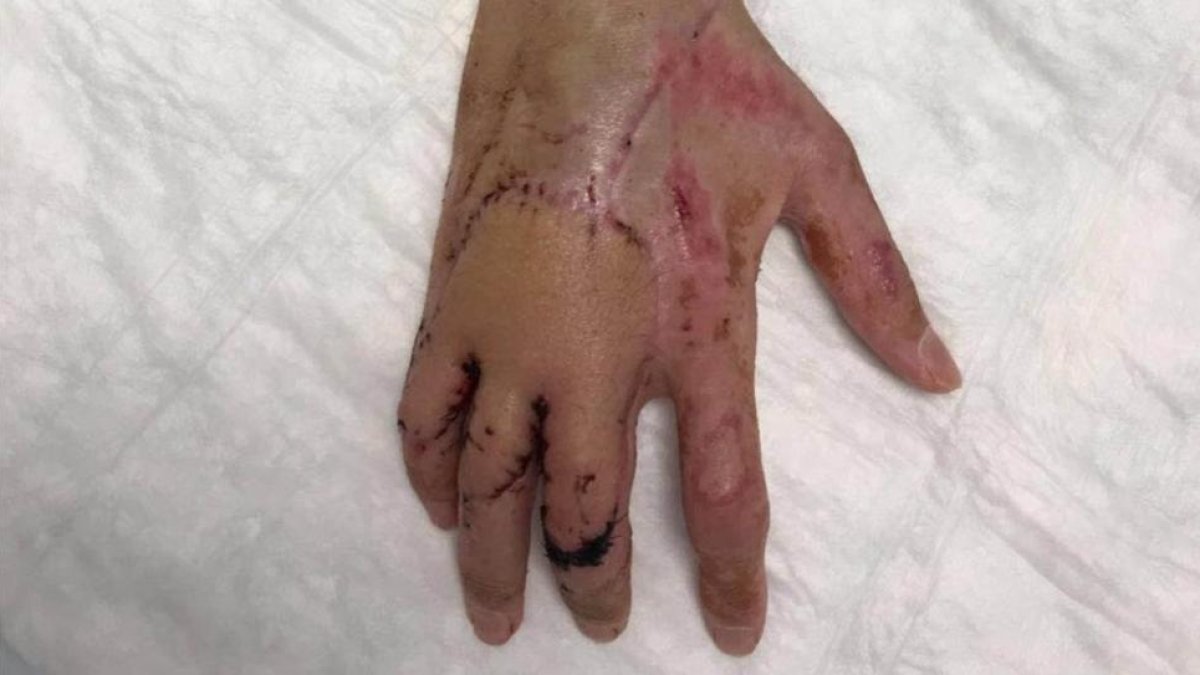 La mano de Bruno Hortelano, reestructurada por el doctor Xavier Mir.-EL PERIÓDICO