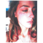 Amber Heard, con las heridas en el rostro que le causó Johnny Depp al lanzarle un teléfono.-REUTERS