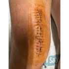 Cicatriz en la pierna de Óscar Puente con la mitad de las grapas ya retiradas.- TWITTER