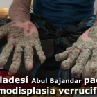 Abul Bajandar se hizo mundialmente conocido por las grandes verrugas que cubrían su cuerpo y que le llevaron a ingresar hace hoy dos años en un hospital de Dacca.-EFE