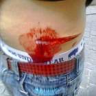 Herida de arma arma blanca que recibió la víctima del neonazi.-E.M.