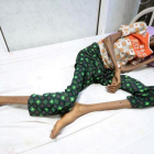 La joven Saida Ahmed Baghili, de 18 años, es atendida en el hospital de Al-Thawra, de la ciudad yemení de Hodeidah, de su severa malnutrición.-REUTERS / ABDULJABBAR ZEYAD
