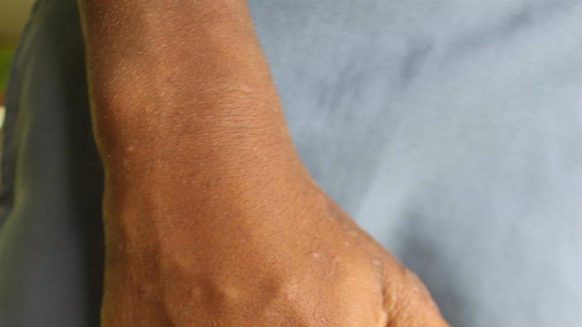 Una imagen de archivo de una persona con sarna