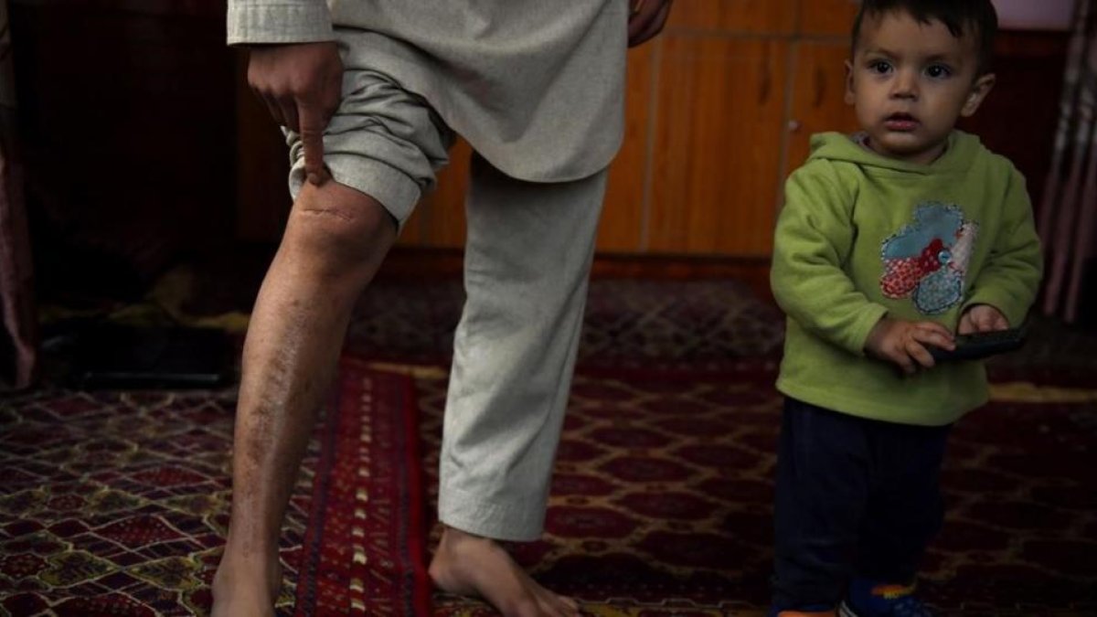 Mohammed muestra sus cicatrices junto a Zamir, su hijo menor.-WAKIL KOHSAR