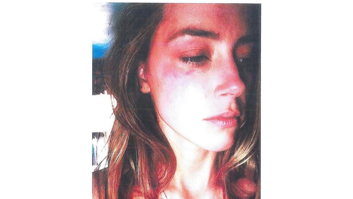 Amber Heard, con las heridas en el rostro que le causó Johnny Depp al lanzarle un teléfono.-REUTERS