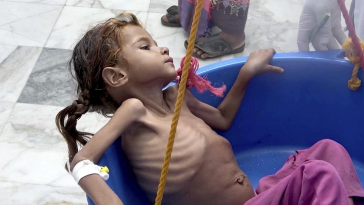 Niña sufre los efectos de la desnutrición-HAMMADI ISSA