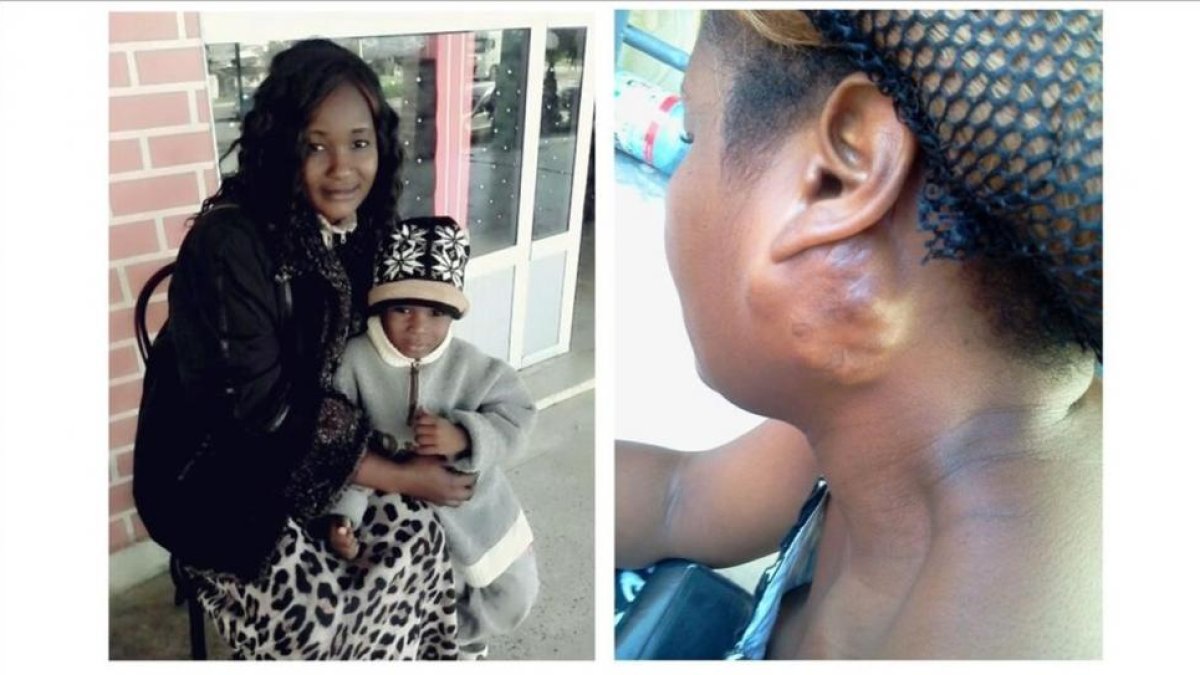 Veronique, con su hijo Samuel, y detalle del tumor que la mujer tenía en el cuello.-