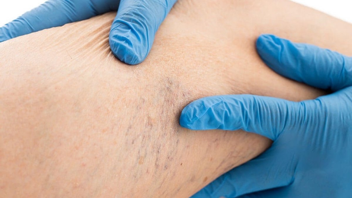 Varices tratamientos sin cirugía para este problema vascular - TheLuxonomist.es