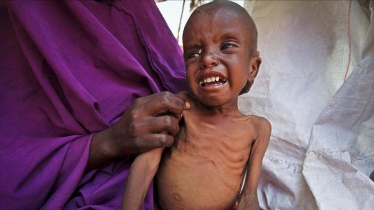Un niño somalí de 7 años que padece malnutrición en el campo de desplazados de Garasbaley, a las afueras de Mogadiscio, la capital de  Somalia.-AP / FARAH ABDI WARSAMEH