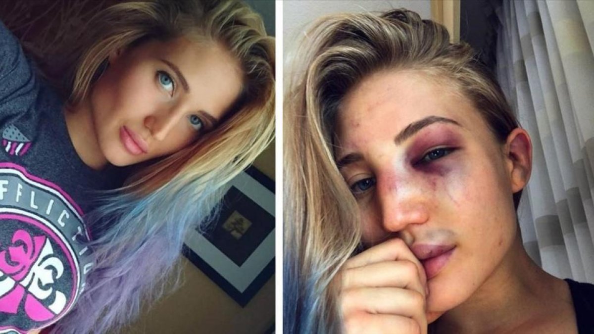 Anastasia Yankova, en sendas imágenes colgadas en su cuenta de Instagram, antes y después de la pelea.-INSTAGRAM