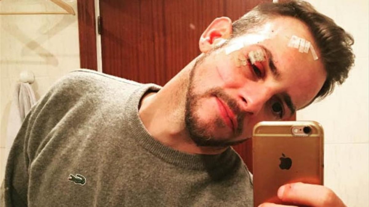 El exconcursante de OT 1, Àlex Casademunt, se hace un selfi con su herida.-/ PERIODICO