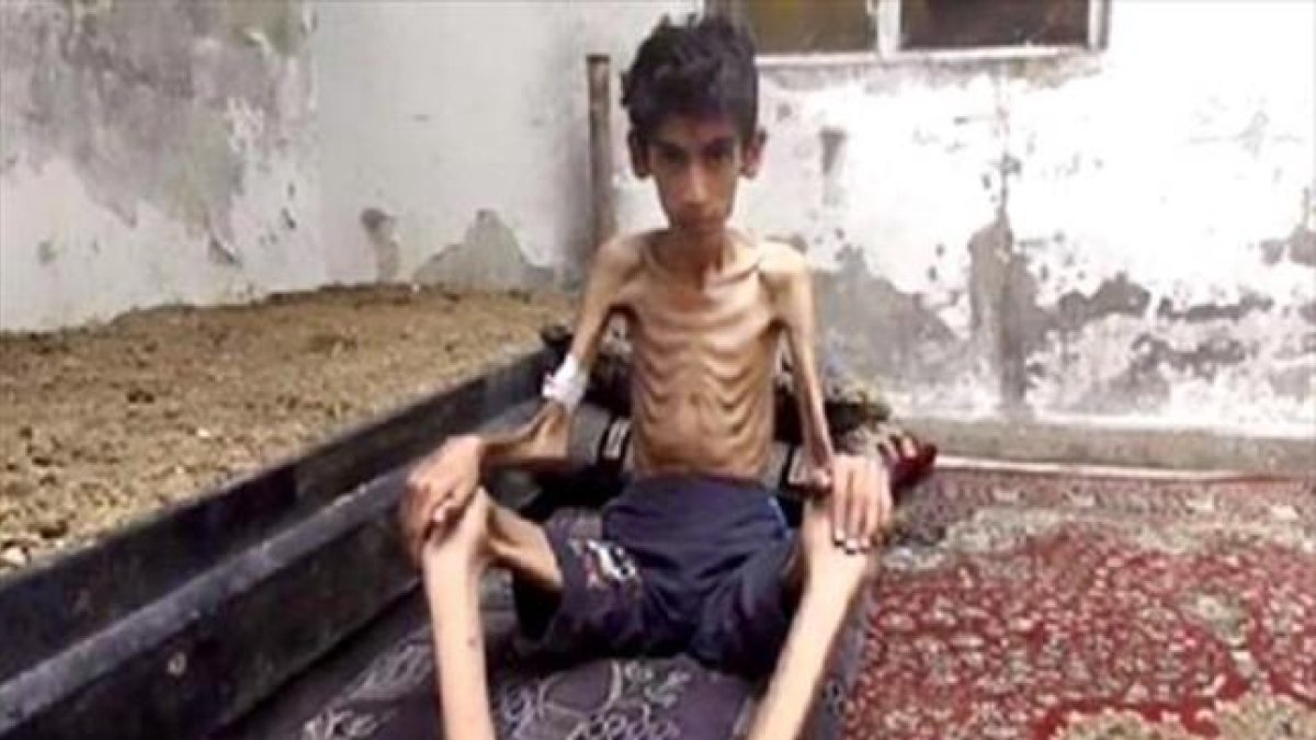 Desnutrición 8Manifestantes con la imagen de un niño, supuestamente de Madaya, en una protesta en Beirut. A la derecha, una foto distribuida por el Consejo Revolucionario de Madaya.-EFE / NABIL MOUNZER - CONSEJO REVOLUCIONARIO MADAYA / AP