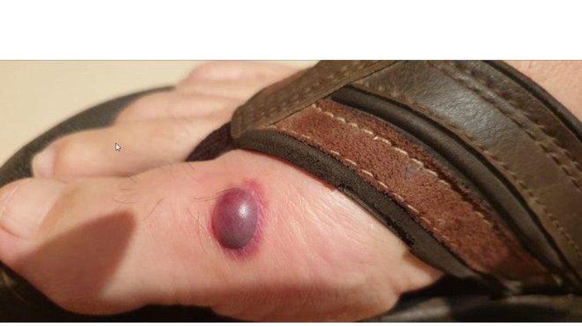 Una de las funcionarias afectadas por picaduras de chinches en la prisión de Valdemoro muestra esta ampolla en uno de sus pies.-N.G.