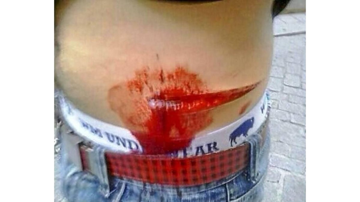 Herida de arma arma blanca que recibió la víctima del neonazi.-E.M.