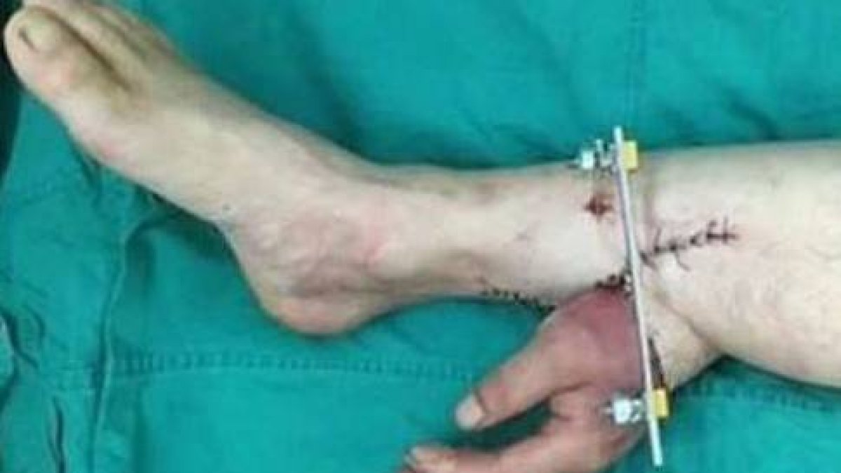 Los cirujanos injertaron la mano en su pierna para mantener el flujo sanguineo.-Foto: CANAL DE TV XXCB