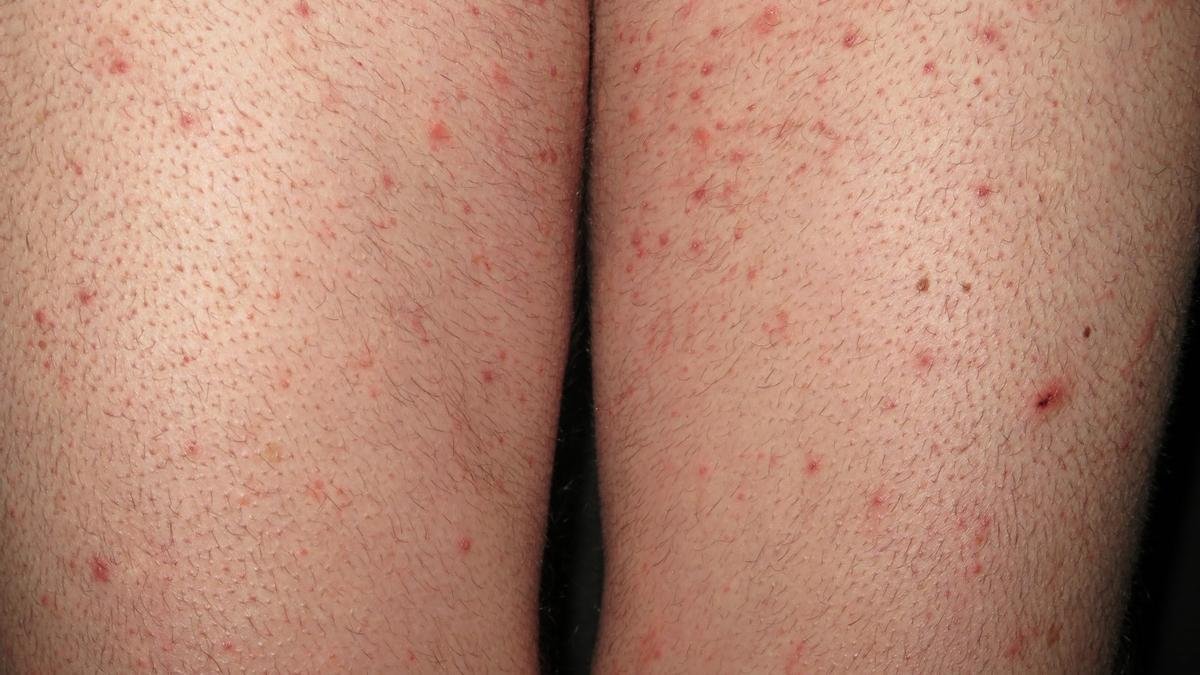 Imagen de archivo de una persona afectada con sarna.