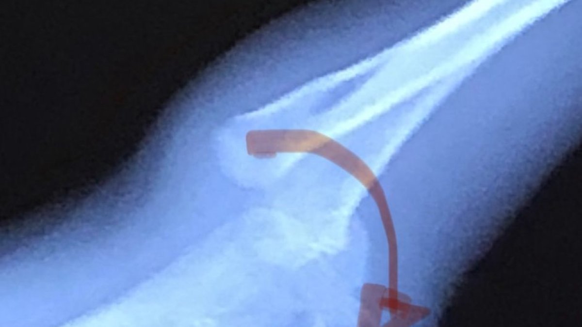 Luxación del codo del niño accidentado con el húmero fuera de la articulación.