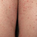 Imagen de archivo de una persona afectada con sarna.